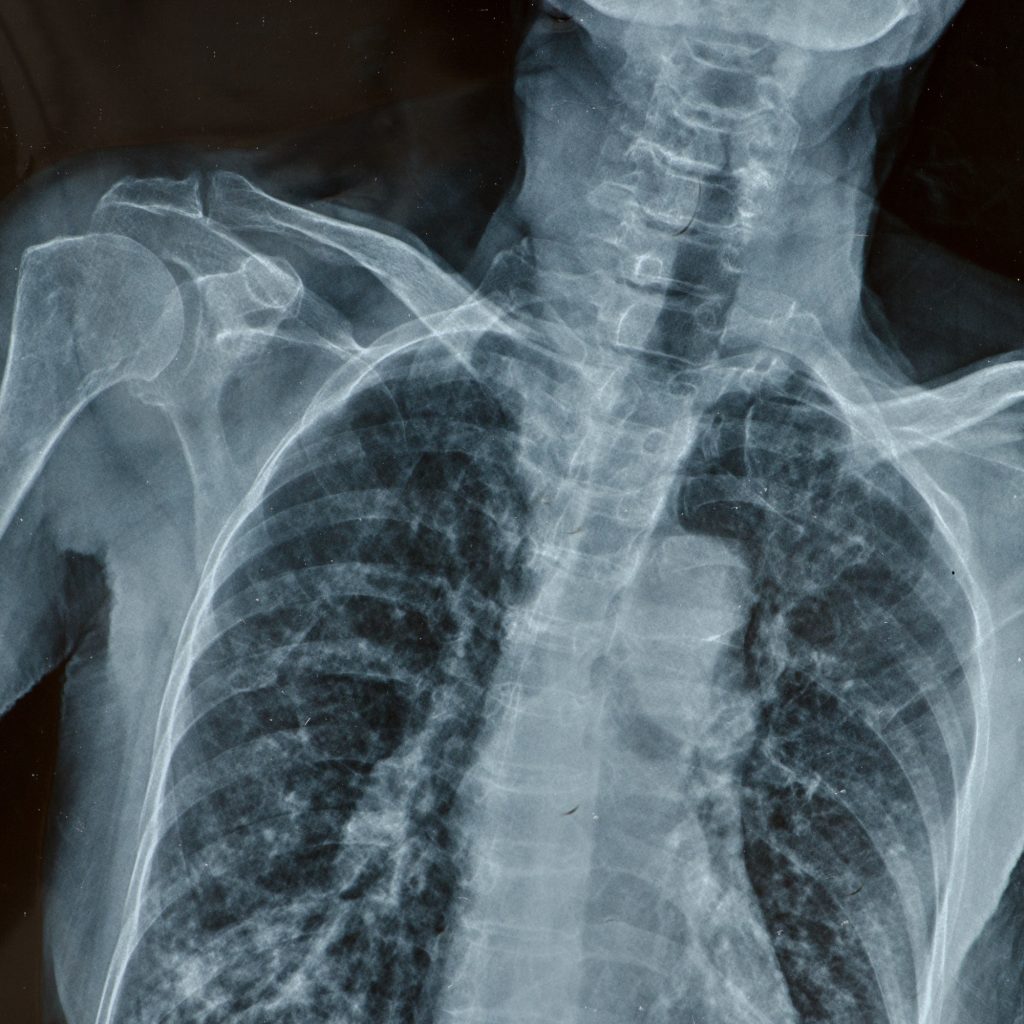 x-rays